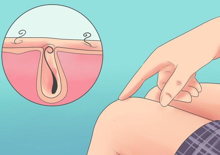 Как бороться с вросшими волосками