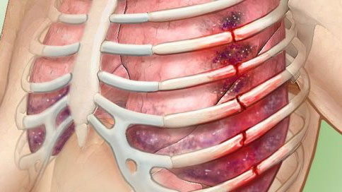 Признаки перелома ребра