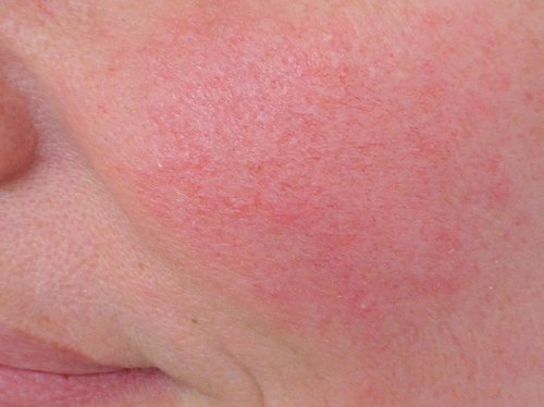 Купероз, как минимизировать его видимость