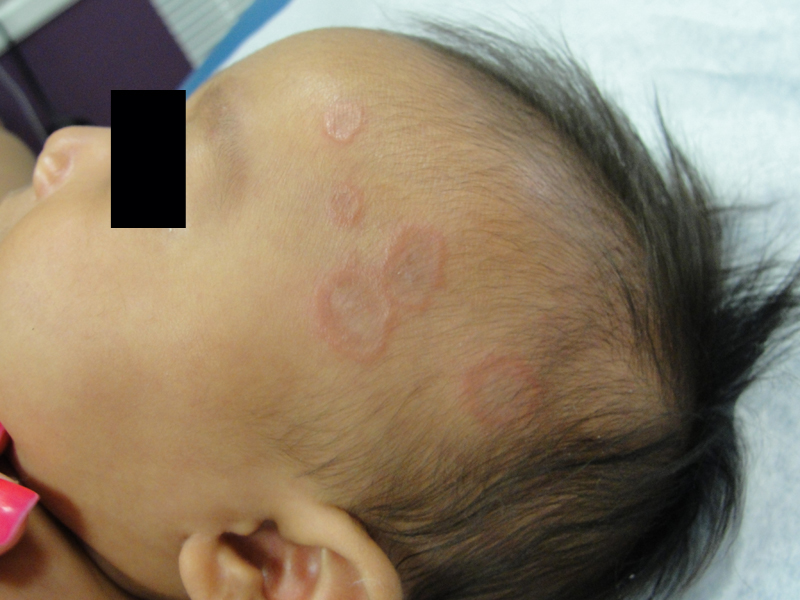 Кольцевидная гранулема у детей