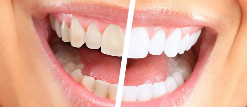 Виды отбеливания зубов