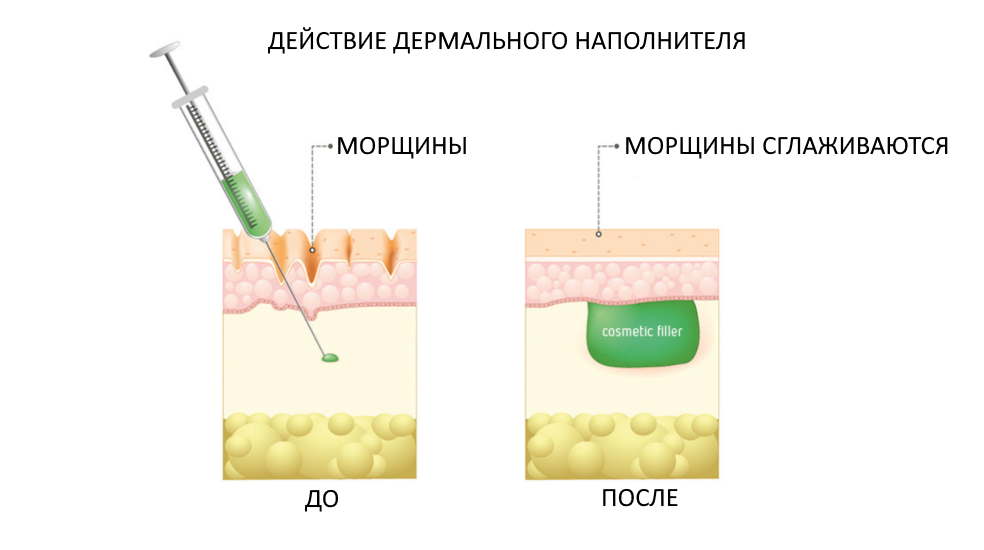 Как действует кожный наполнитель или dermal filler