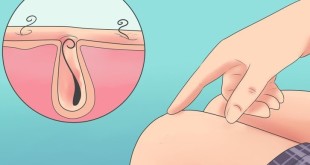 Как бороться с вросшими волосками