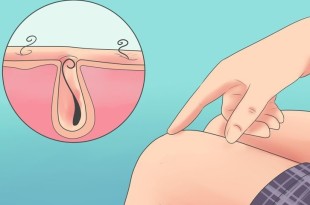 Как бороться с вросшими волосками