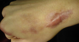 Удаление коллоидных рубцов