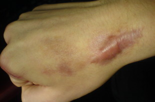 Удаление коллоидных рубцов