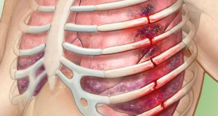 Признаки перелома ребра