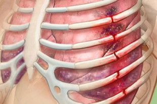 Признаки перелома ребра