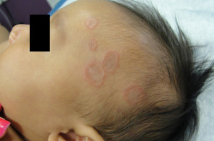 Кольцевидная гранулема у детей